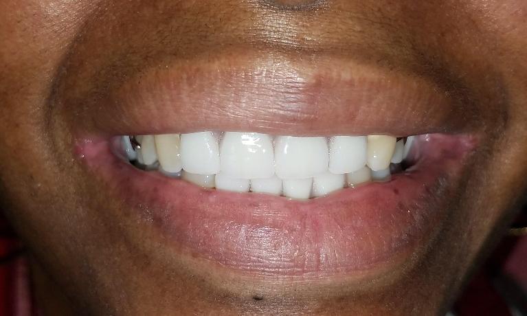 Denture smile..jpg