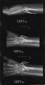 Dawns X-Ray wrist.jpg