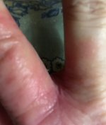 damaged_finger_070420_1_IMG_6985.JPG