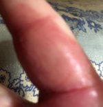 damaged_finger_070420_4_IMG_6990.jpg